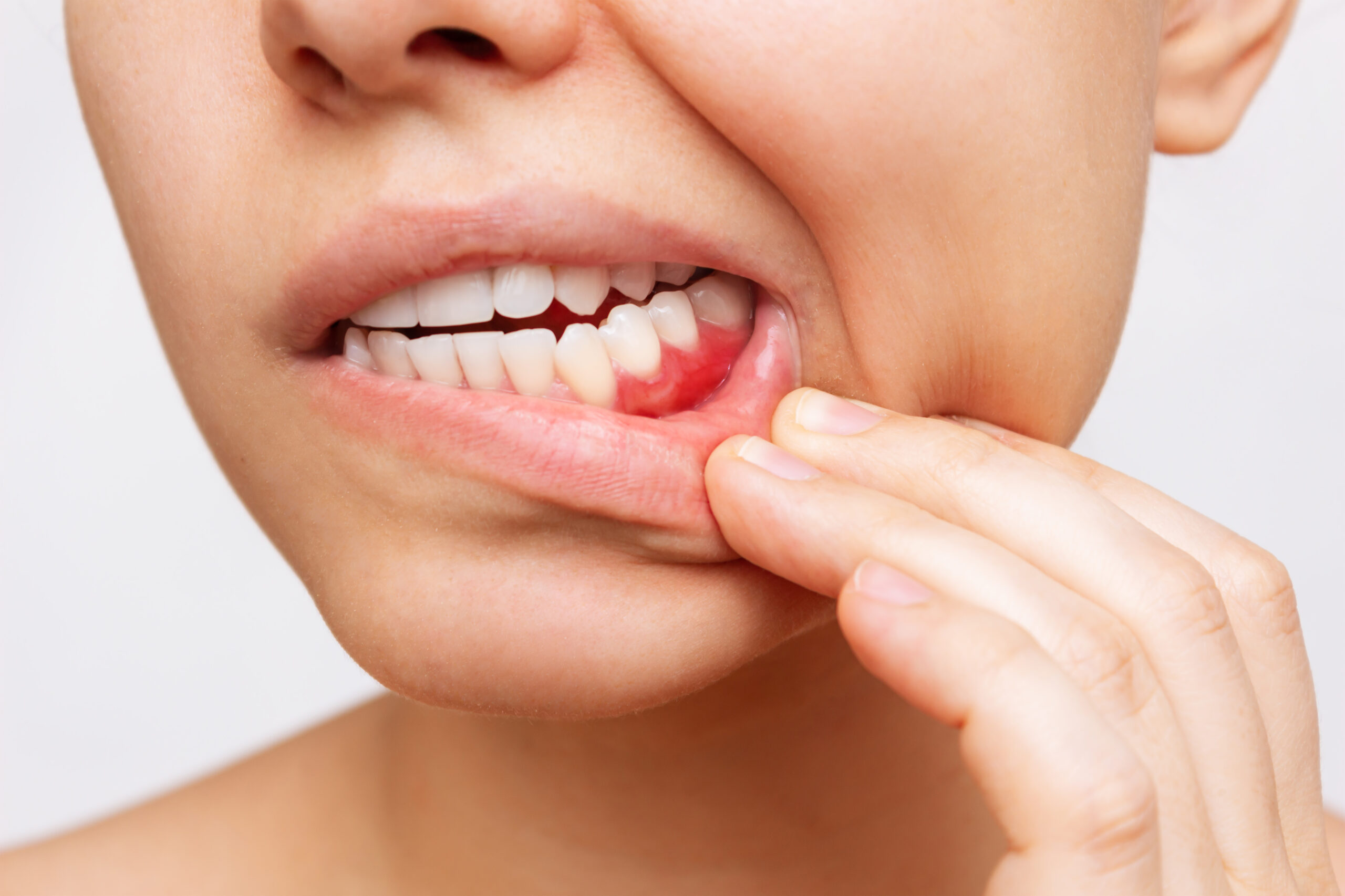 ¿Que es la enfermedad periodontal scaled