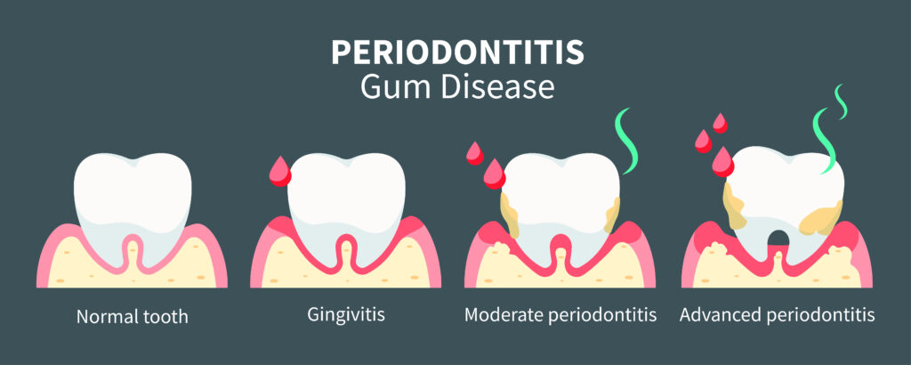 ¿Que es la enfermedad periodontal Dentro1